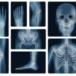 China desarrolla un adhesivo óseo que fija fracturas en minutos
